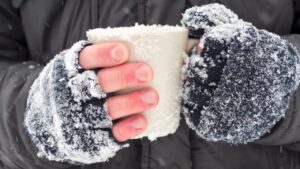 How to Get Rid of a Frostbite Scar - Effective Strategies