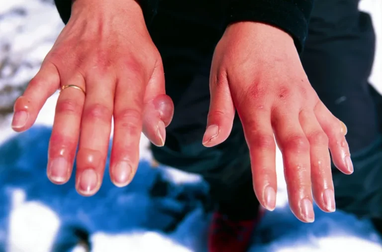 How to Get Rid of a Frostbite Scar